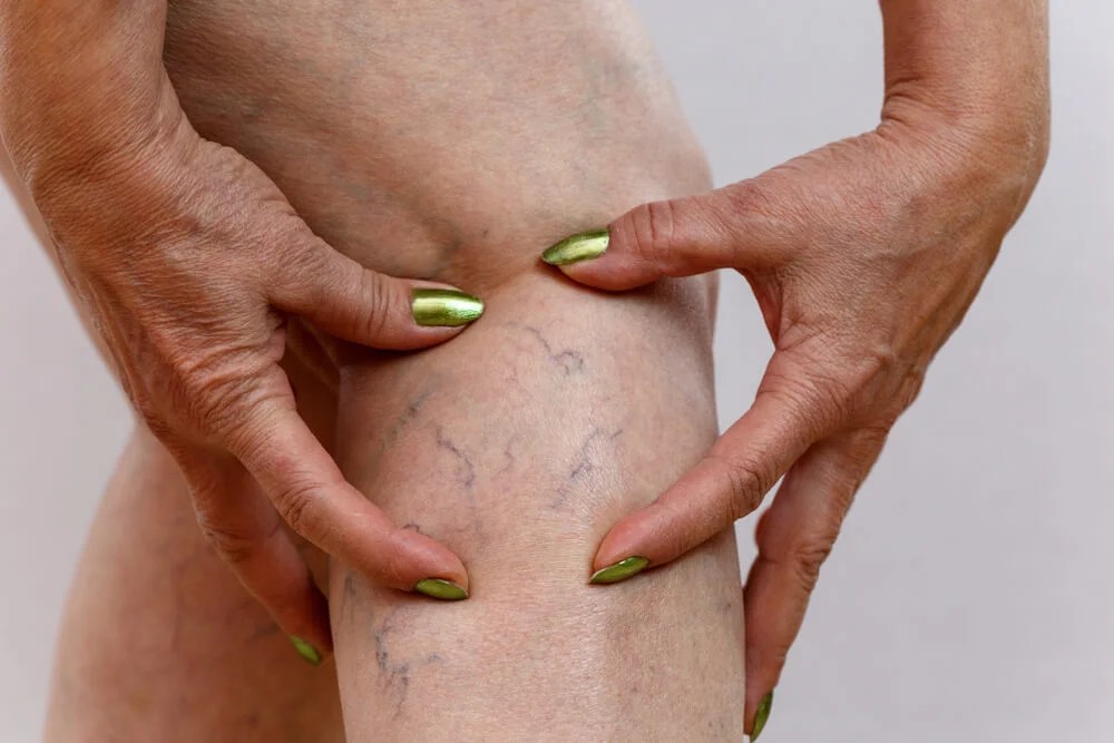 Trombofilia e Maternidade: O desafio invisível que ameaça as mulheres no Rio Grande do&nbsp;Norte.